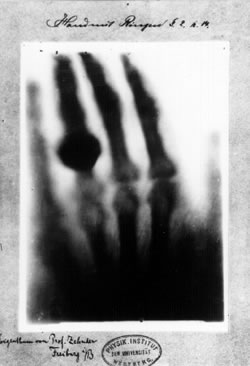 Wilhelm Conrad Roentgen et la première radiographie de la main de sa femme (1895)